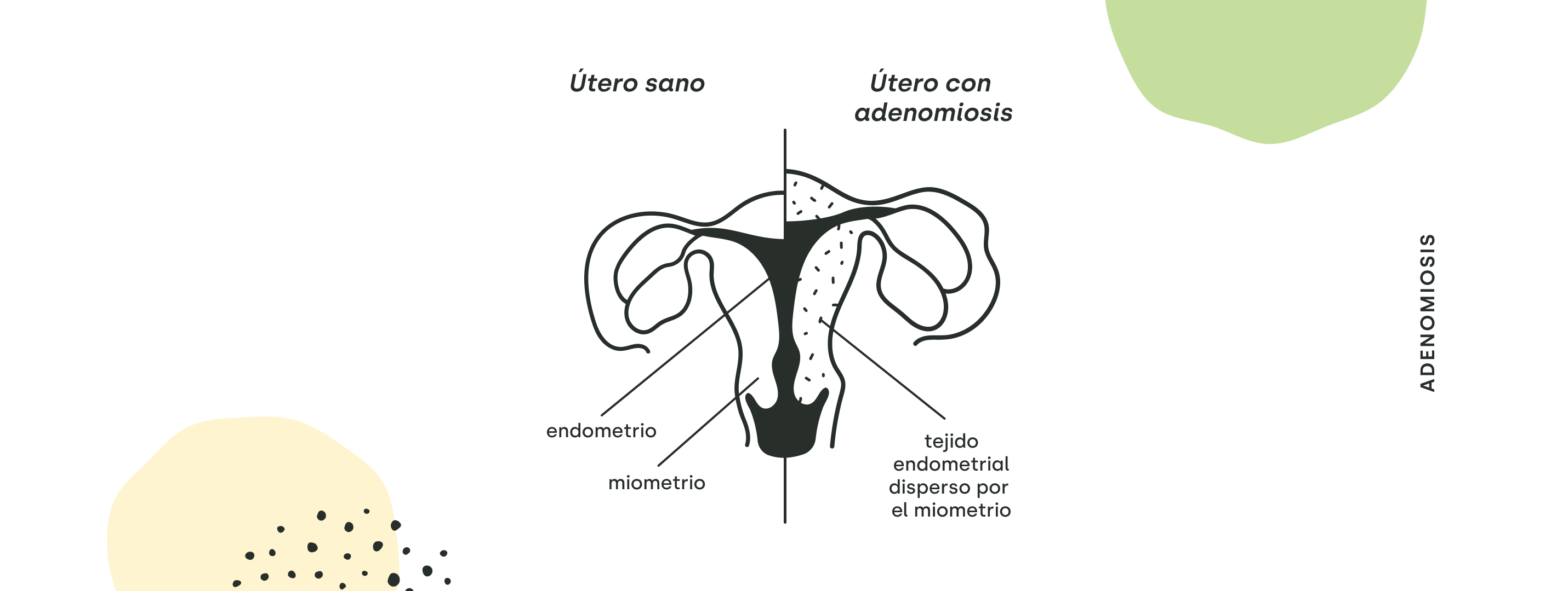 adenomiosis y endometriosis sintomas ciclo menstrual